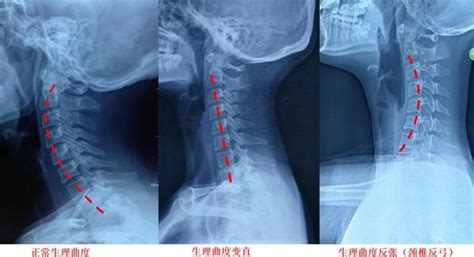 反弓|什么是颈椎反弓？颈椎反弓怎么治疗最好的方法